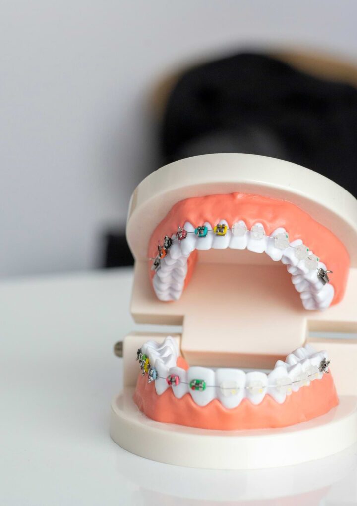 Overdenture: Benefits and Alternatives